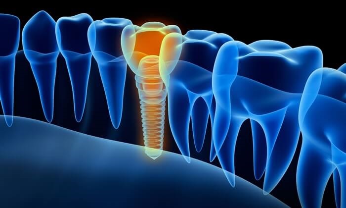 Tipos de Implantes Dentários