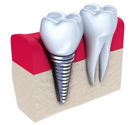 Implantes Dentários em Campinas Clínica de Odontologia Dr. Marcelo Minekawa